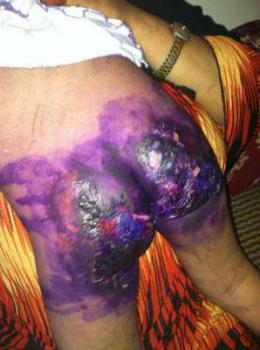 تعذيب طفلة عمرها خمس سنوات وإحراقها بصنعاء (صورة) تعذيب طفلة عمرها خمس سنوات وإحراقها بصنعاء (صورة)