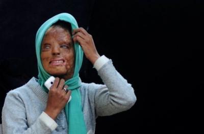 طالبة في الجامعة رفضت تودد ثلاثة من زملائها الطلاب فأحرقوا وجهها بالأسيد لتصبح مليونيرة