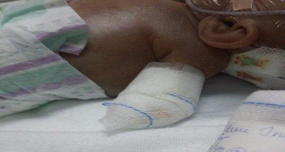 والده يطالب بالتحقيق... خطأ طبي يتسبب في سقوط يد طفل من جسده ووفاته بالسعودية