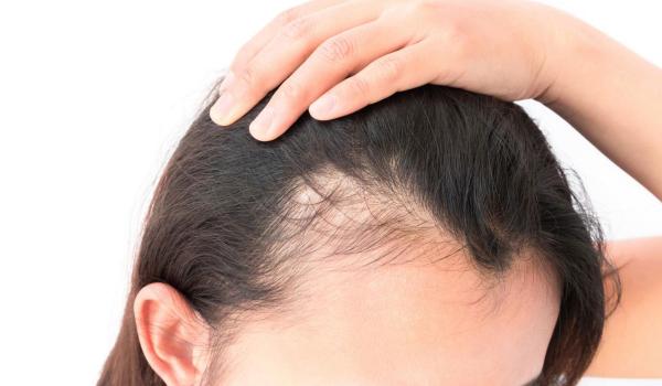 طرق علاج تساقط الشعر عند الرجال والنساء والأطفال