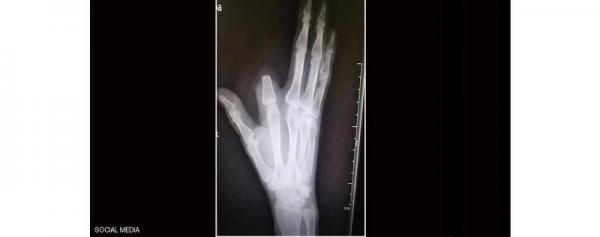 قطع إصبعه بسبب لدغة أفعى.. والمفاجأة كانت صادمة