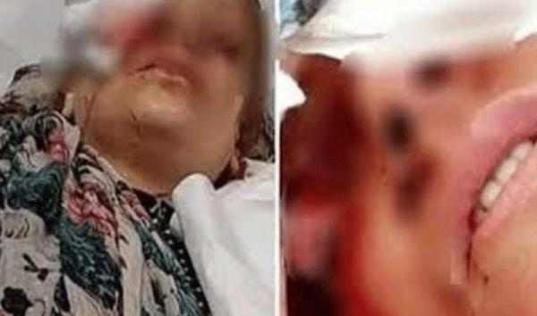 الأطفال هربوا من مشهد الأم المروع.. أردنية تروي واقعة فقء عينيها بيدي زوجها