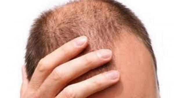 الكشف عن مشروب يسهم في الحماية من تساقط الشعر والصلع