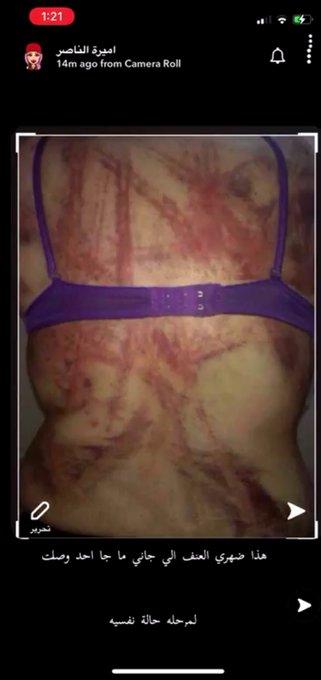 أميرة الناصر تفاجئ الجميع بصور مرعبة لتعنيف طليقها لها