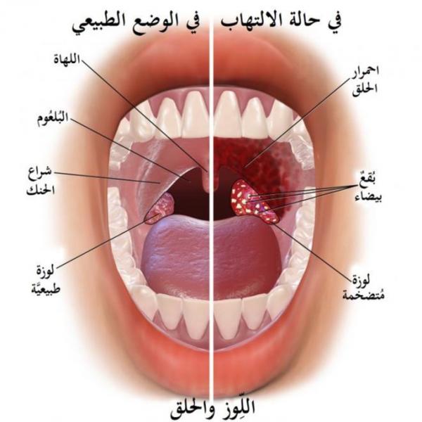 تعرف على أفضل طرق علاج التهاب الحلق واللوزتين بالأعشاب الطبيعية 