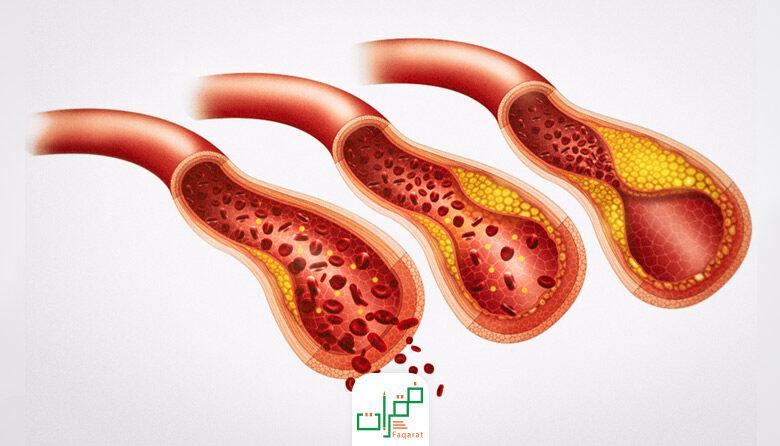 أسباب ارتفاع الدهون الثلاثية والفريق بينها والكولسترول