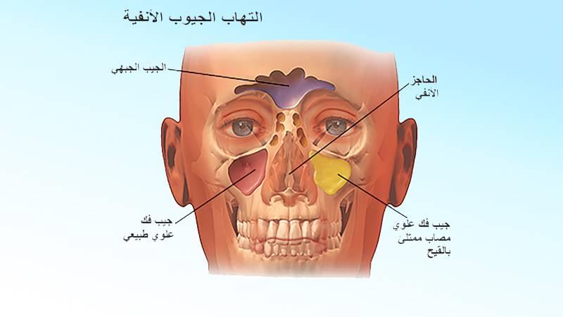  كيف تعالج التهاب “الجيوب الأنفية” بنفسك؟