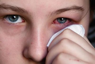 5 نصائح للتخلص من احمرار العين