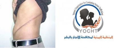 لاول مرة في اليمن.. عصابة تتزعمها امرأة تتاجر بالأعضاء البشرية تقع في قبضة الأمن (أسماء العصابة والمتورطين)