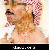 سعودية تحرق زوجها بـ"الأسيد" لزواجه بأخرى 