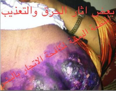 تعذيب طفلة عمرها خمس سنوات وإحراقها بصنعاء (صورة)