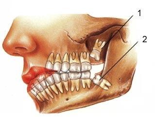 ما سبب تسمية ضرس العقل بهذا الاسم ؟