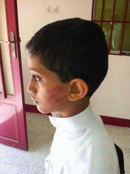 أكاديمي يمني بجامعة نجران يشوّه وجه ابنه ضرباً (صورة)
