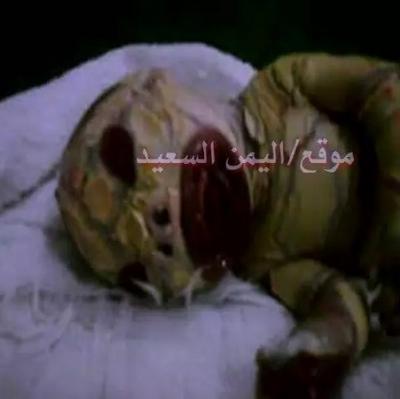 في حالة نادرة ..إمرأة تلد طفلا بصورة حيوان مفترس عيون واسعة - اسنان بارزة - انف تشبه الغورلا (صور)