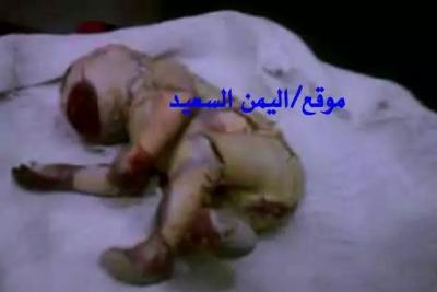 في حالة نادرة ..إمرأة تلد طفلا بصورة حيوان مفترس عيون واسعة - اسنان بارزة - انف تشبه الغورلا (صور) في حالة نادرة ..إمرأة تلد طفلا بصورة حيوان مفترس عيون واسعة - اسنان بارزة - انف تشبه الغورلا (صور)