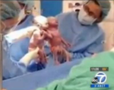 فيديو مؤثر.. طفلة تخرج من بطن أمها ممسكة بيد أختها