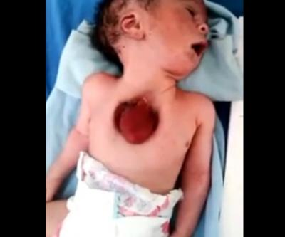 شاهد بالفيديو كيف يتحرك: في حالة نادرة.. ولادة طفل في اليمن وقلبه خارج القفص الصدري (سبحان الله)