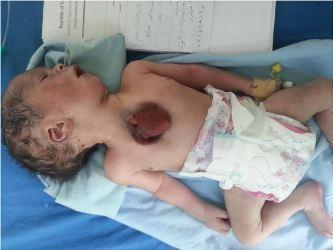 وفاة الطفل اليمني الذي ولد وقلبه خارج صدره (صورة)