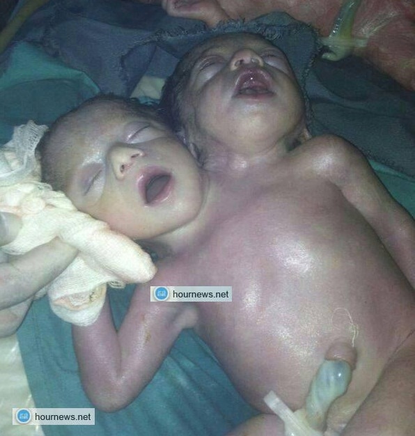 من الحالات النادرة باليمن مولود بمستشفى السبعين اليوم له جسم واحد ورأسين  (صورة )