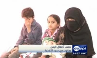 نصف أطفال اليمن يعانون من سوء التغذية (فيديو)
