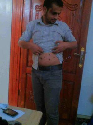  الحوثيون يعذبون أحد طلاب جامعة صنعاء حرقا بالسجائر « صورة »