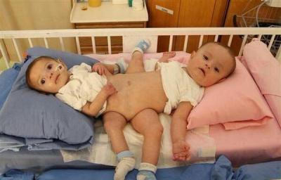 نجاح عملية فصل توأم سيامي يمني في مستشفى الحرس الوطني بالسعودية