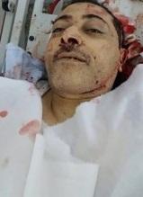 شاهد بالصورة… القيادي الحوثي عبدالكريم الخيواني بعد اغتياله