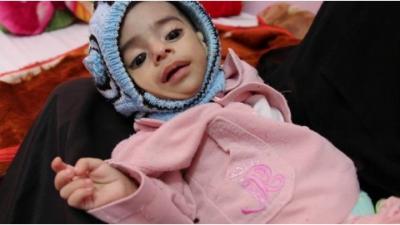 الأمم المتحدة: "7.6 مليون شخص في اليمن على شفا المجاعة"