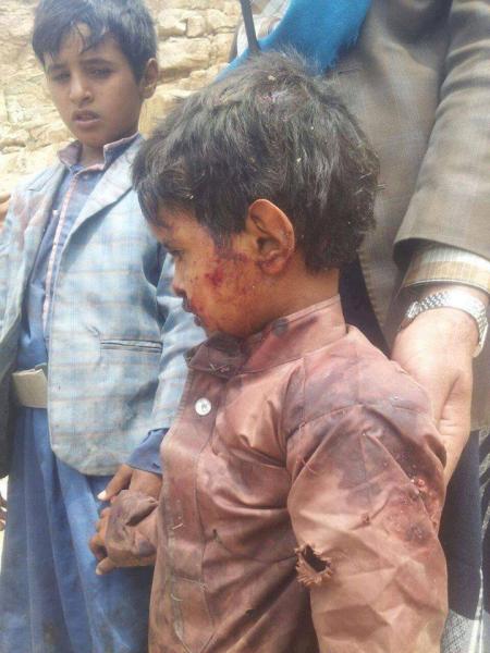 طفل يمني ينجو من الموت على غرار الطفل السوري "عمران" (صورة)