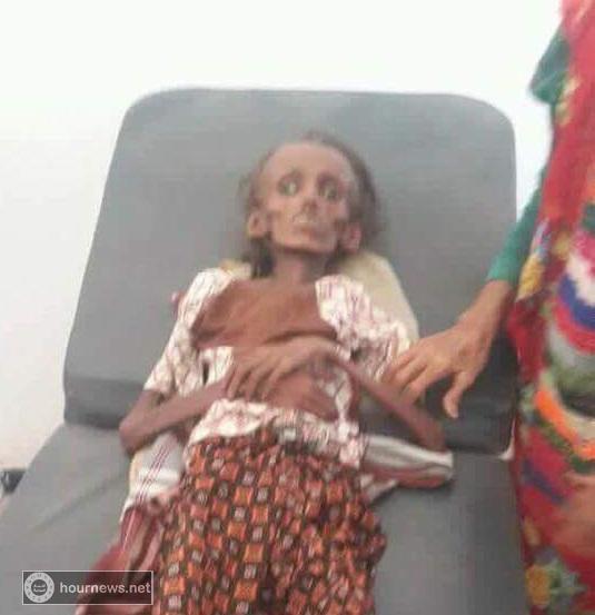 شاهد صورة مؤلمة.. هذه ليست مومياء محنطة .. هذه امرأة يمنية تلفظ انفاسها الاخيرة