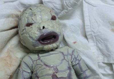 حادثة غريبة وعجيبة! أذهلت الأطباء والمختصون وجعلتهم في حيرة من أمرهم! إثر ولاده هذا الطفل (صورة)