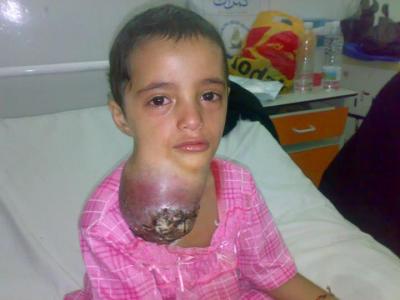 (بالصور) مرض خبيث يخنق طفلة يمنية "قصة مأساوية"