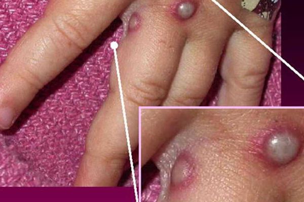 مرض خطير يهدد العالم.. والأطفال الأكثر عرضةً للإصابة