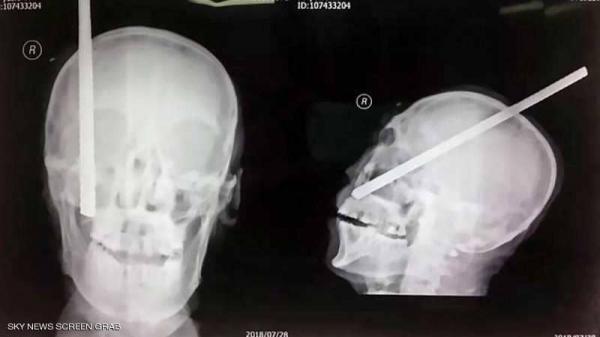 عامل ينجو من الموت.. رغم دخول قضيب لمسافة 20 سم في جمجمته