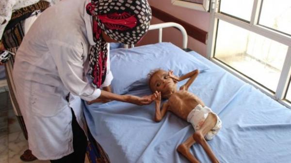 الأمم المتحدة: استمرار حرب اليمن يهدد بأسوأ مجاعة منذ 100 عام وموت 13 مليون شخص جوعا
