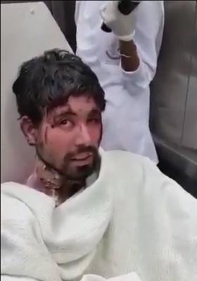 شاهد بالفيديو: إصابة مقيم في السعودية بحروق خطيرة جراء إنفجار هاتفه الخلوي