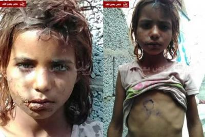في عدن  ..بنت  عثروا عليها وقاموا بتربيتها ثمّ عذّبوها بوحشيّة!!«صور»