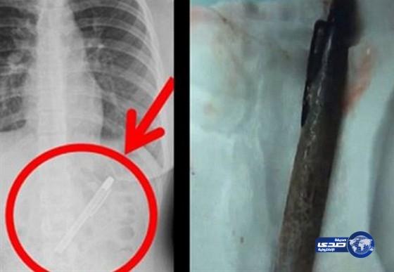 فتاة احتفلت بنهاية الامتحانات وابتلعت قلم نسيته في معدتها ستة أشهر -صورة
