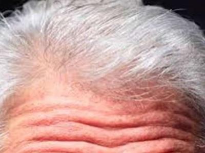 طريقة فعالة 100% لمكافحة الشيب