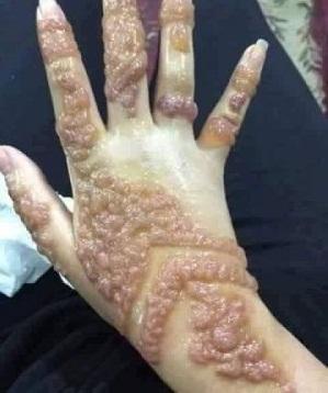 طبيب يمني يحذر النساء من الحناء الصناعية ويكشف مخاطره 