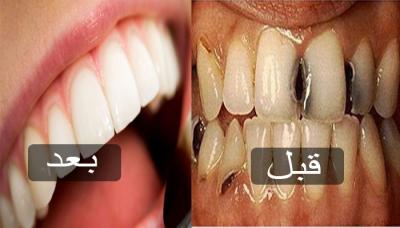 تعرف على هذه الطريقة الرائعة والبسيطة للتخلص من تسوس الاسنان والجير المتراكم عليها