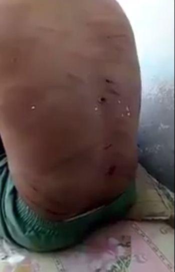 شاهد بالفيديو : اثار تعذيب نجل ابو كرده نائب ضابط امن مطار عدن الذي اعتقلته قوات الحزام الأمني التابعة للامارات (اليمن)