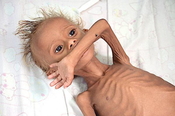 الغذاء العالمي: 16مليون يمني يكافحون من أجل الحصول على الطعام