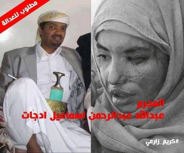 صنعاء:القبض على زوج العنود الذي قام بإحراق جسدها بالأسيد(صورة)