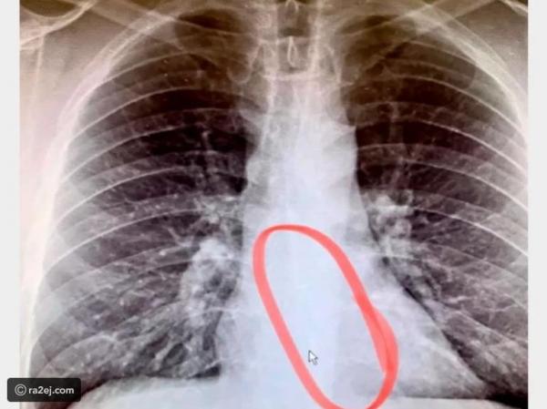شخص يبتلع  سماعة بقيمة 129 دولار أثناء نومه